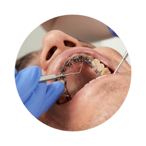 Lingualspangen für Erwachsene