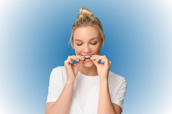 Warum spricht jeder über Aligner?